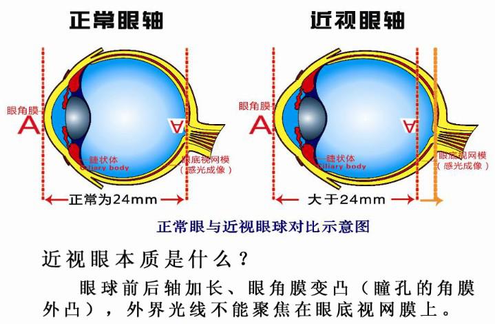 近視本質